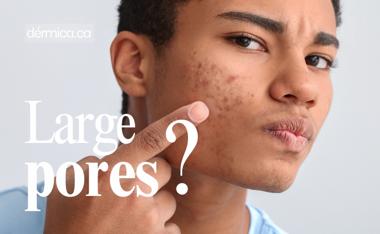 how to close open pores on face