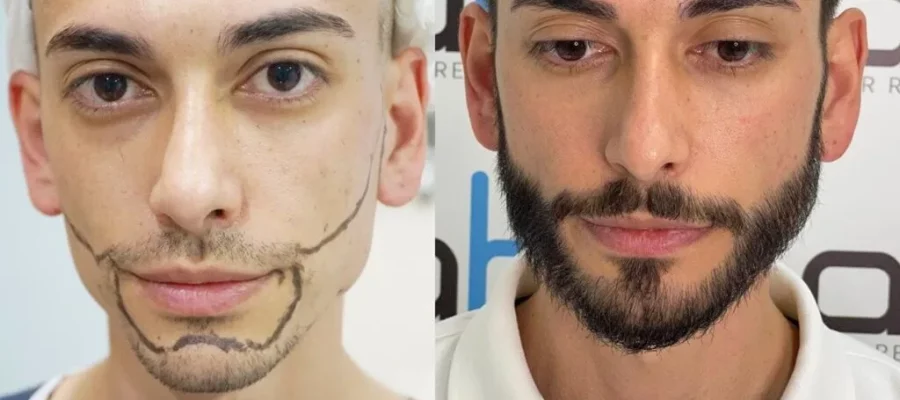 beard transplants in pakistan