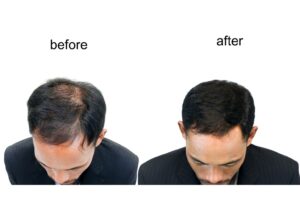 microneedling hair growth
